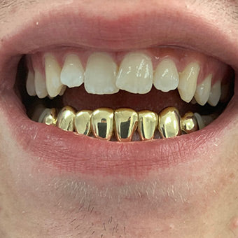 10k deals gold grillz