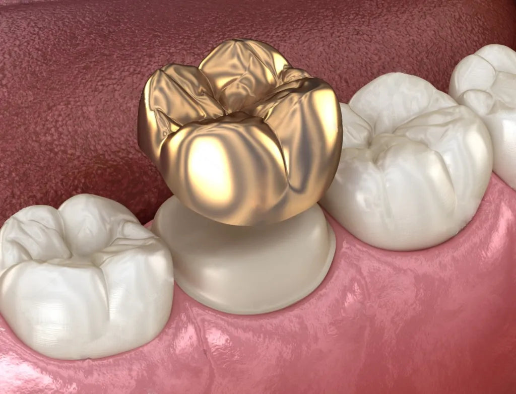 22kt Permanent teeth /crowns