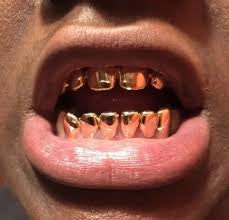 22kt Permanent teeth /crowns